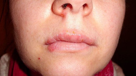 Auch Stress begüns­tigt Herpes