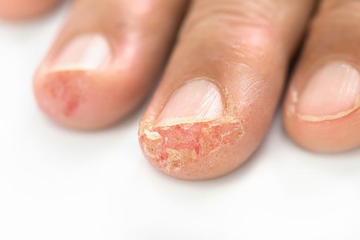 Hil­fe bei auf­ge­platz­ten Fingerkuppen